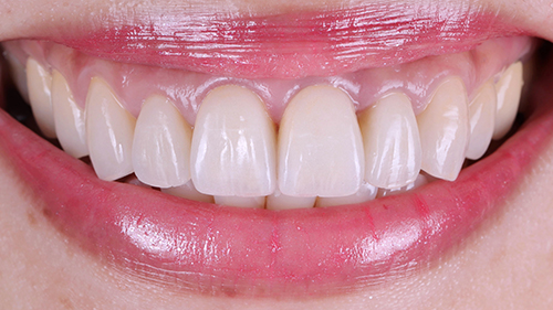 01前牙美學 1 牙冠增長術 仿真全瓷