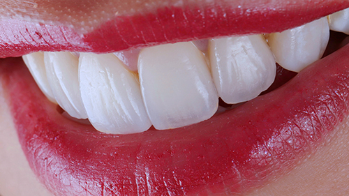 02前牙美學 2 牙齒美白 仿真全瓷