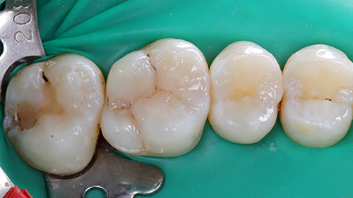 03. 擬真樹脂修復加上適當的窩溝染色