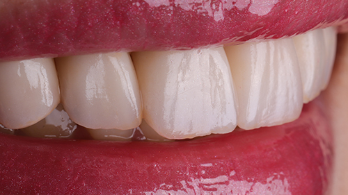 03前牙美學 3 牙冠增長術 仿真全瓷