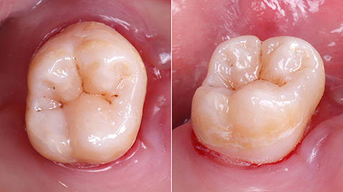 04. 移除橡皮障 Rubber Dam