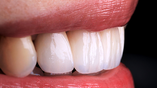 04前牙美學 4 前牙仿真全瓷