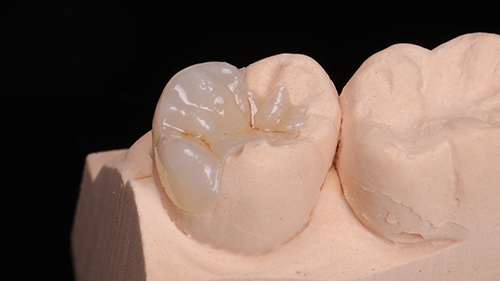 07 03. 成品近照. 精緻的陶瓷嵌體 Onlay 呈現牙齒應有的細節