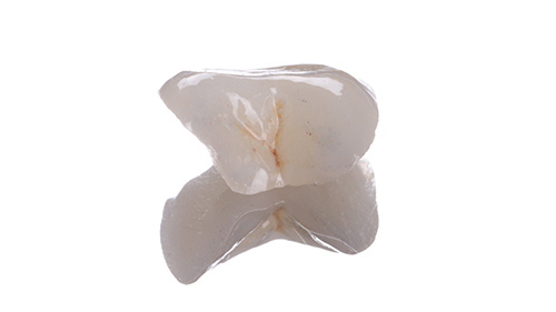 10 03. 成品近照. 小臼齒的嵌體成品