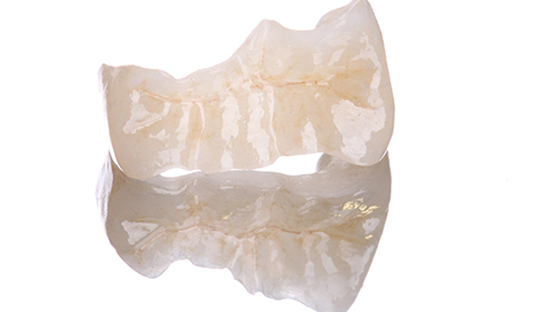 12 04. 第一大臼齒的嵌體成品